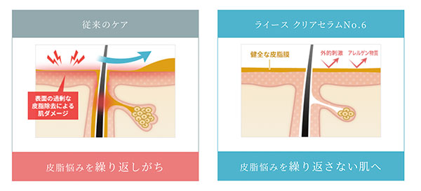 ニキビと皮脂腺の関係