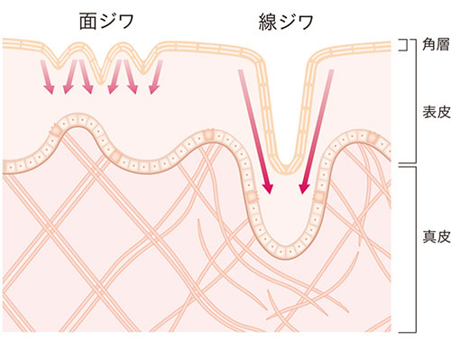 面じわと線じわの説明