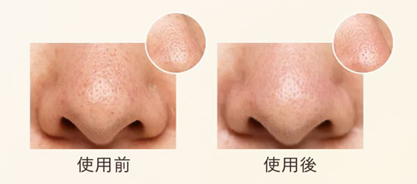 使用前使用後毛穴